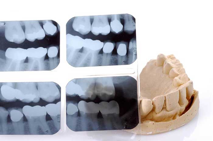 X-ray of teeth