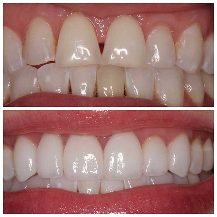 Before and after teeth