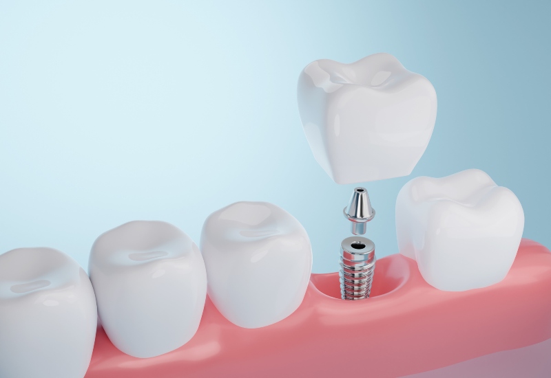 A 3D illustration of dental implant components, aiding in choosing the right type in Germantown, TN