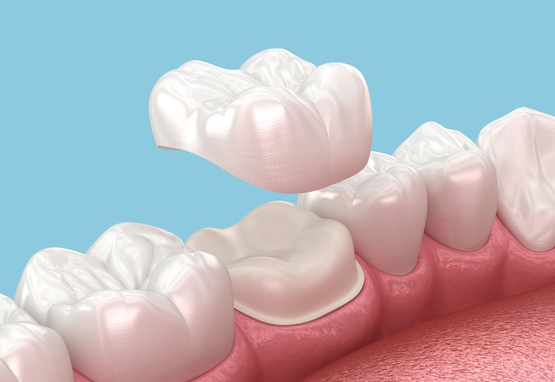 A 3D rendering of dental crown placement, explaining when and why it's needed in Germantown, TN