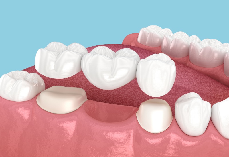 3D dental bridge illustration showing tooth gap restoration to prevent bite issues in Germantown, TN