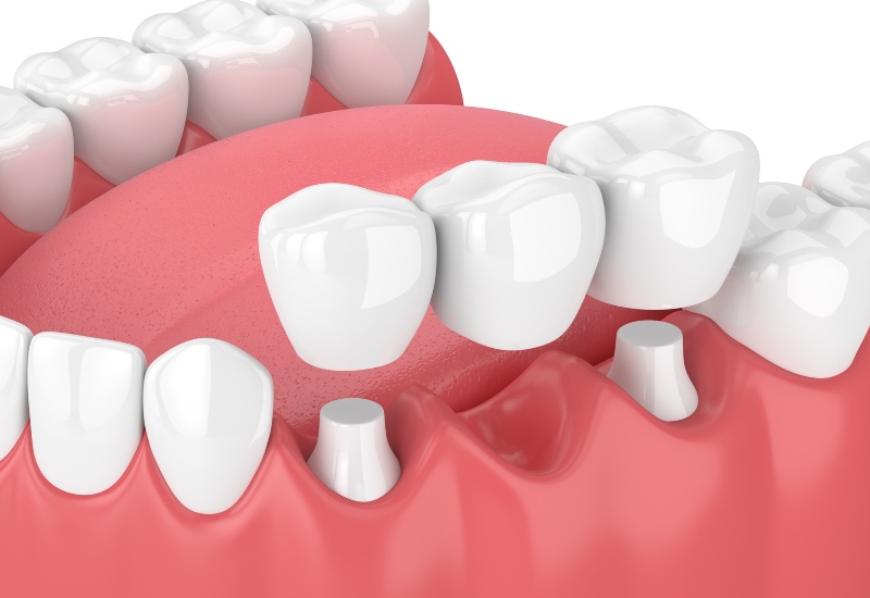 3D illustration of a dental bridge above prepared teeth replacing a missing tooth in Germantown, TN