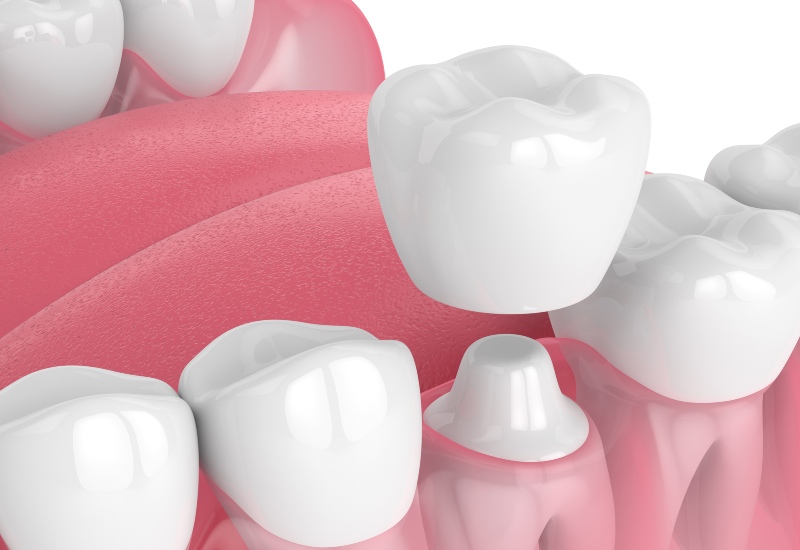 3D illustration of a dental crown placed over a prepared tooth for restoration in Germantown, TN